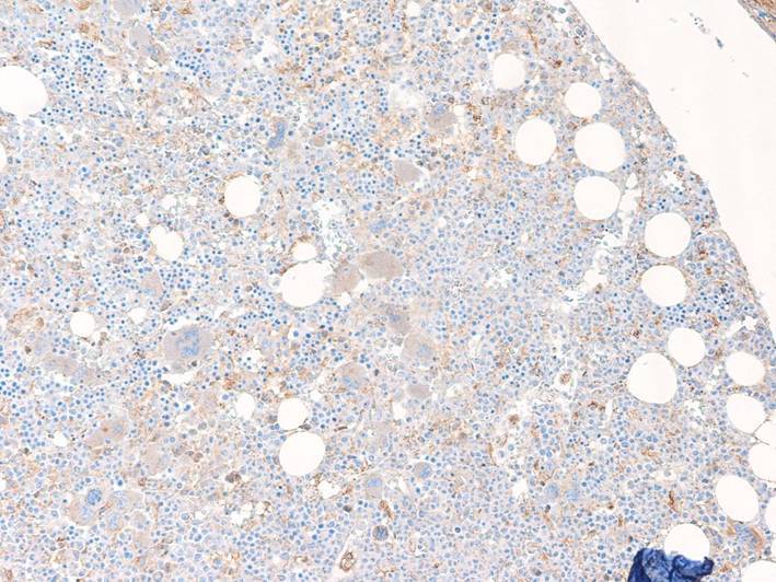 second bone marrow TdT